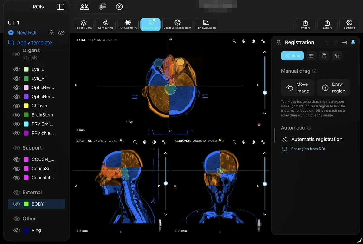 RadContour's Registration view fusing a head CT with a secondary series, one shown in blue and the other in orange across axial, sagittal and coronal panes, with manual drag and automatic registration controls in the side panel.